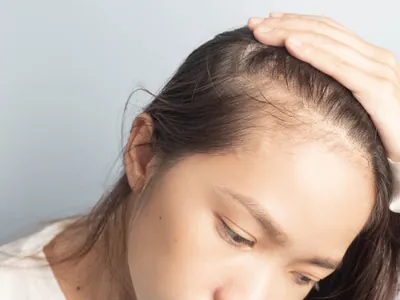 Mulher afastando o cabelo e observando a linha de entrada rarefeita